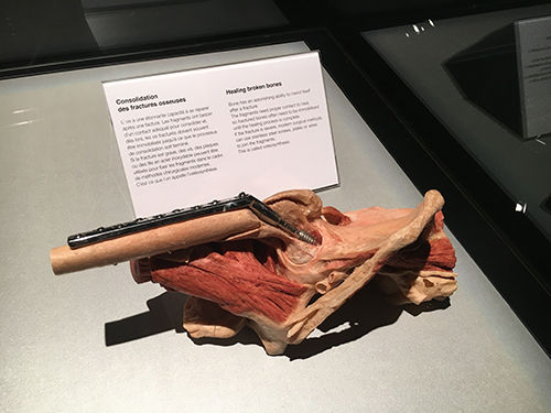 bodyworlds fractured bone