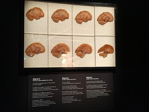 bodyworlds migraine